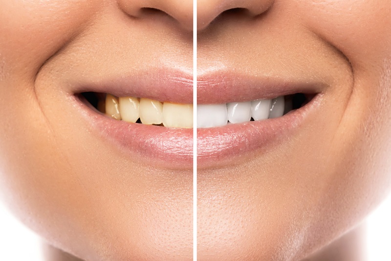 5 wskazówek, aby mieć zdrowe, białe zęby. Naturalne metody.